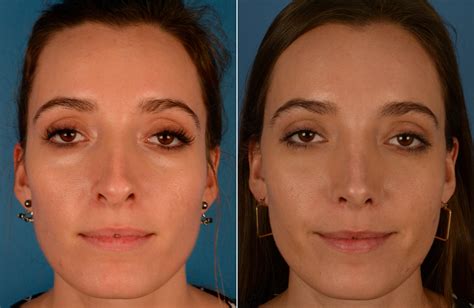 Overall, the average cost varies between 3000 and 15000, depending on the requirements. . Ultrasonic rhinoplasty florida